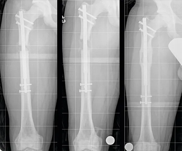 X-ray comparison of internal lengthening nail in femur bone during limb lengthening